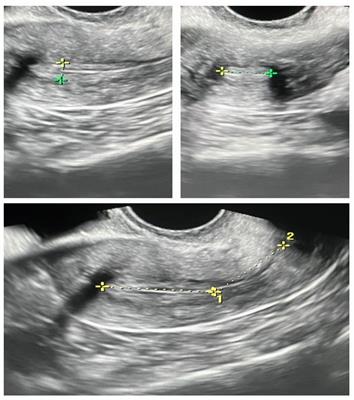 Enhancing endometrial receptivity in FET cycles: exploring the influence of endometrial and subendometrial blood flow along with endometrial volume